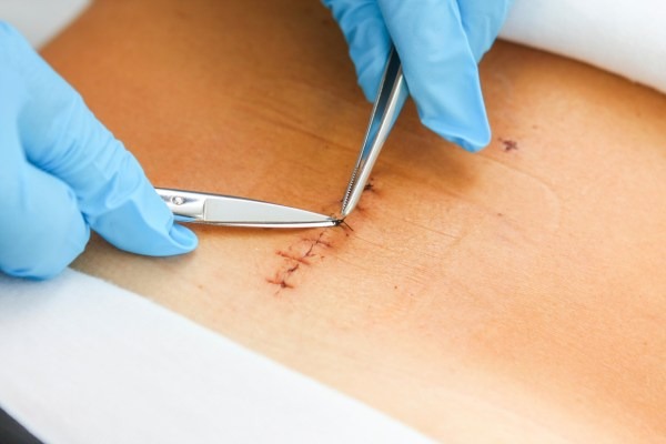 Evde Dikiş Atma ve Dikiş Alma Hizmeti – Profesyonel Sağlık Ekibi ile Güvenli Müdahale