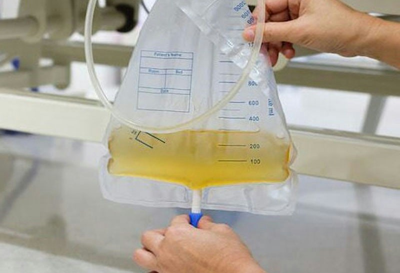 İdrar Sonrası Sonda Değişimi